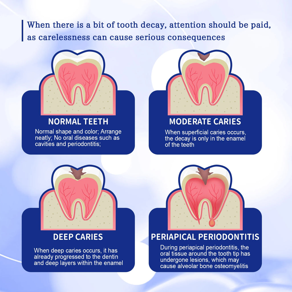 Anti Decay Toothpaste Dental Caries Repair Cream Prevent Tooth Decay Protect TeethDeep Clean Whitening & Fresh Breath Toothpast